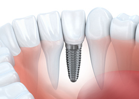 機能的で、長持ちするインプラント歯科素材を使用し、患者様に安全なインプラント治療を行っていきます。